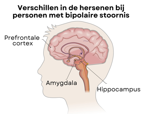 Welke gebieden in de hersenen verschillen bij personen met bipolaire stoornis?